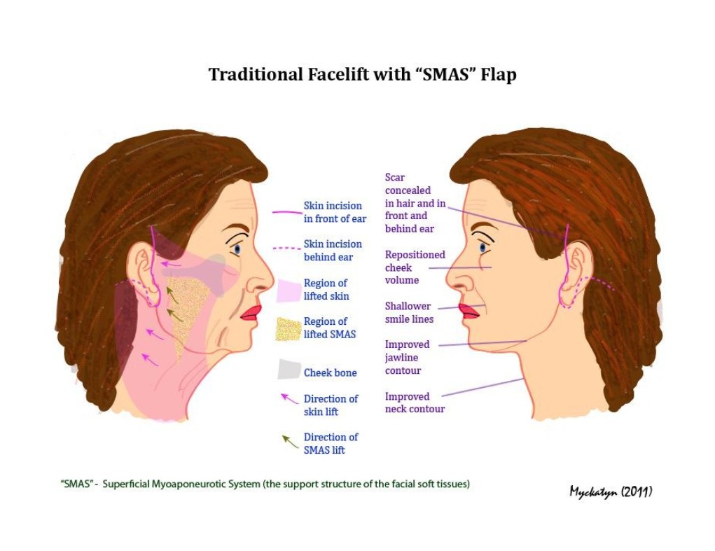 Face lift surgery