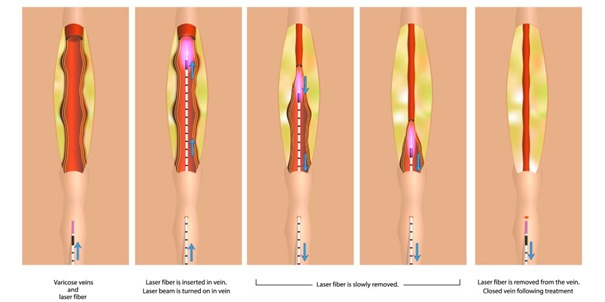 Endovenous Laser Treatment