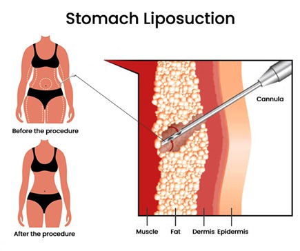Liposuction