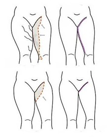 Thigh lift