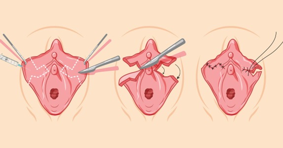 What Is Labioplasty Surgery