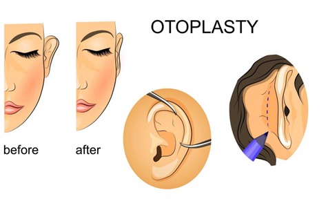 Eyelid surgery