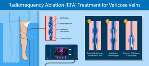 Radiofrequency Ablation