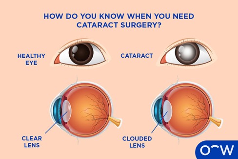 Cataract Surgery